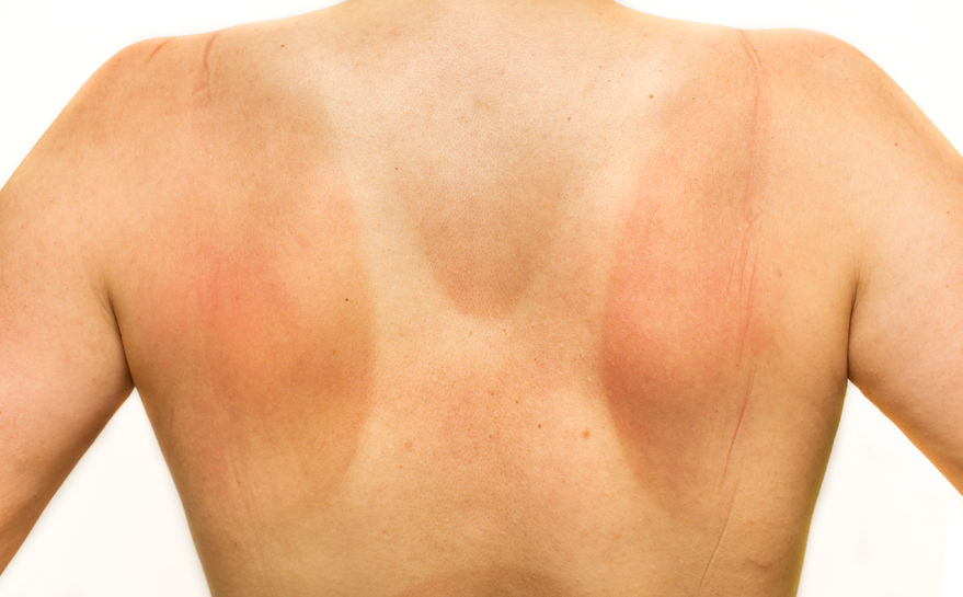Health Concerns of Sunlight Exposure